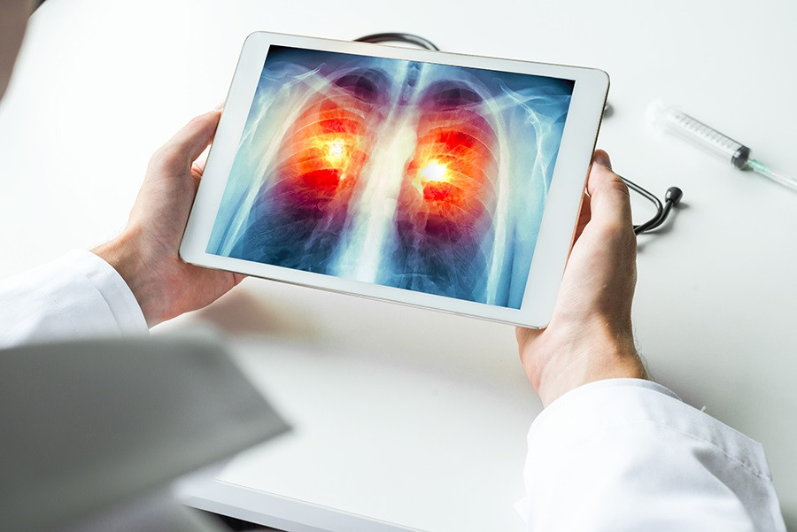 Arquivo - Radiografía dixital acerca dun cancro de pulmón
