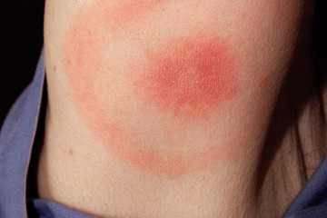 Erythema migrans   erythematous rash in Lyme disease   PHIL 9875