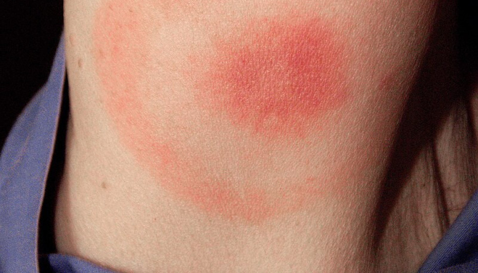 Erythema migrans   erythematous rash in Lyme disease   PHIL 9875