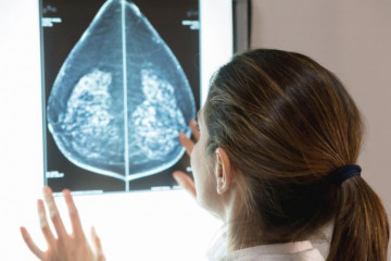 Cribado de cáncer de mama con una imagen obtenida en un mamógrafo