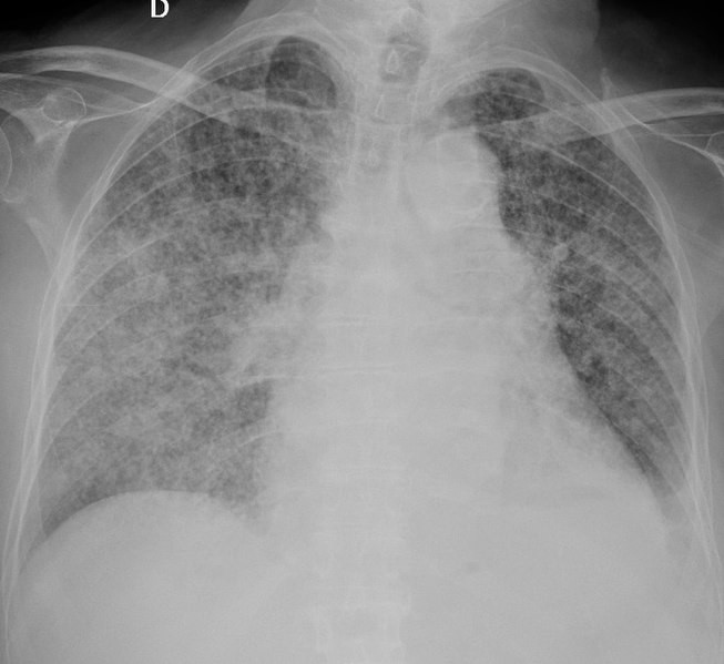 653px Chest radiograph of miliary tuberculose 2