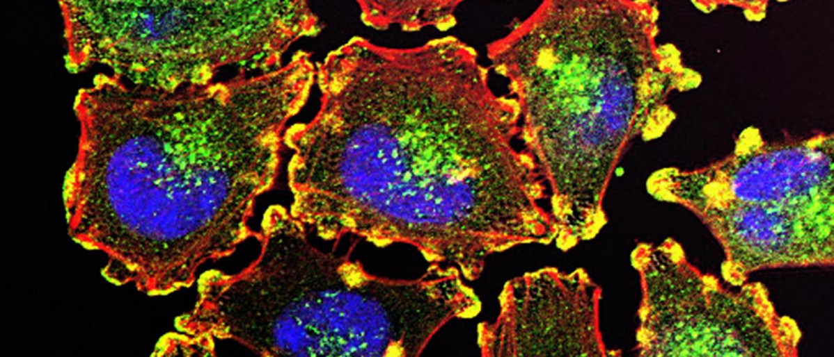 Metastásico melanoma cells nci juliocvalencia