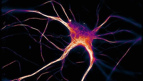 Arquivo - Unha célula cerebral funcional que expresa tau enferma propia do Alzheimer.