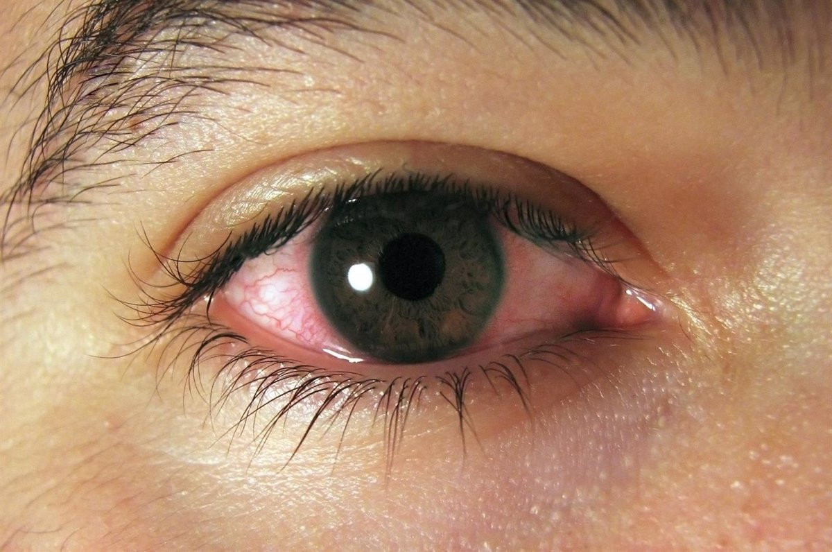 Ojos rojos